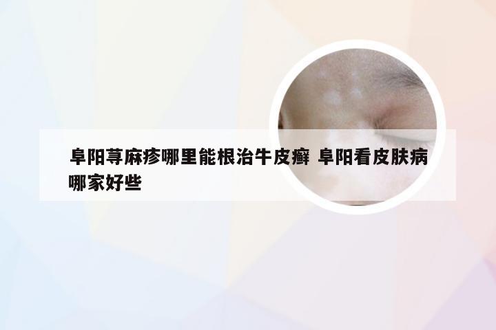阜阳荨麻疹哪里能根治牛皮癣 阜阳看皮肤病哪家好些