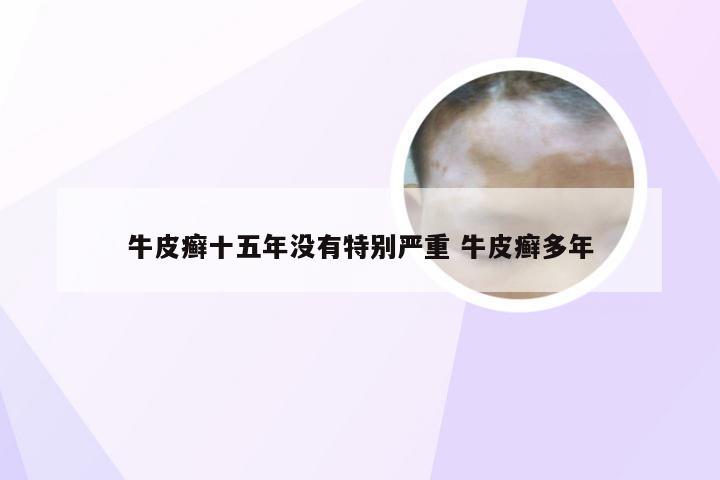 牛皮癣十五年没有特别严重 牛皮癣多年