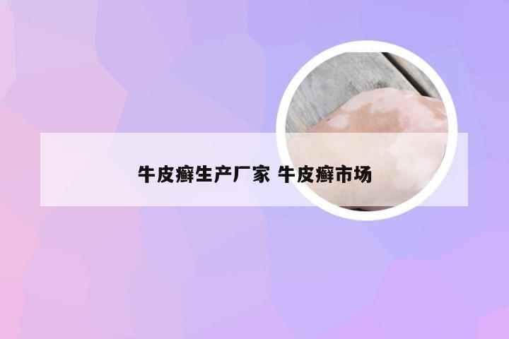 牛皮癣生产厂家 牛皮癣市场