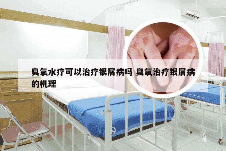 臭氧水疗可以治疗银屑病吗 臭氧治疗银屑病的机理