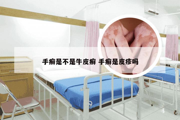手癣是不是牛皮癣 手癣是皮疹吗