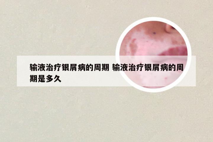 输液治疗银屑病的周期 输液治疗银屑病的周期是多久