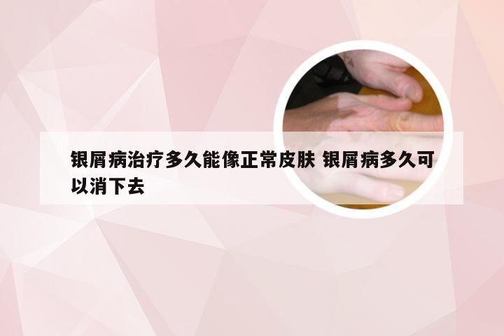 银屑病治疗多久能像正常皮肤 银屑病多久可以消下去