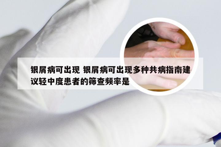 银屑病可出现 银屑病可出现多种共病指南建议轻中度患者的筛查频率是