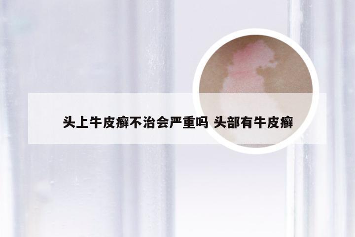 头上牛皮癣不治会严重吗 头部有牛皮癣