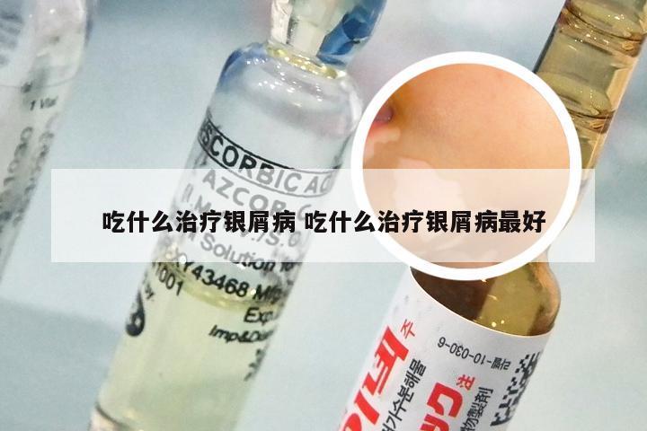 吃什么治疗银屑病 吃什么治疗银屑病最好
