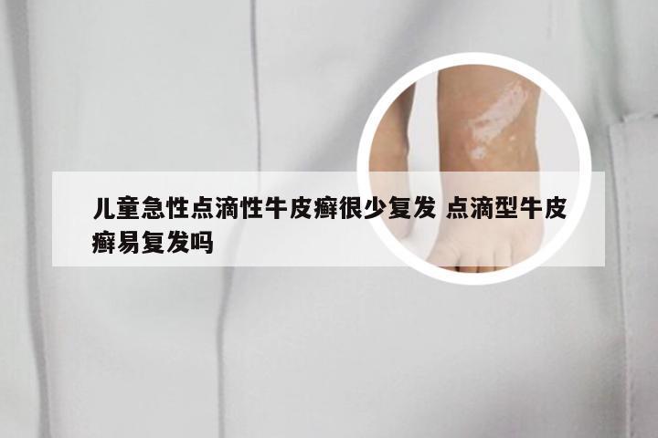 儿童急性点滴性牛皮癣很少复发 点滴型牛皮癣易复发吗