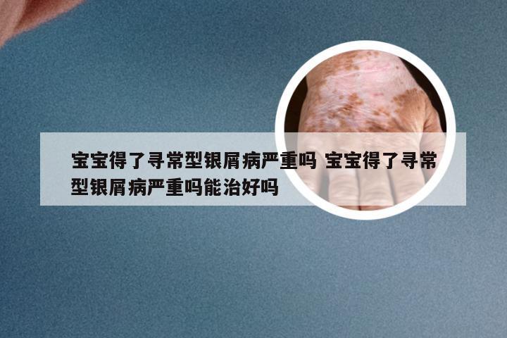 宝宝得了寻常型银屑病严重吗 宝宝得了寻常型银屑病严重吗能治好吗