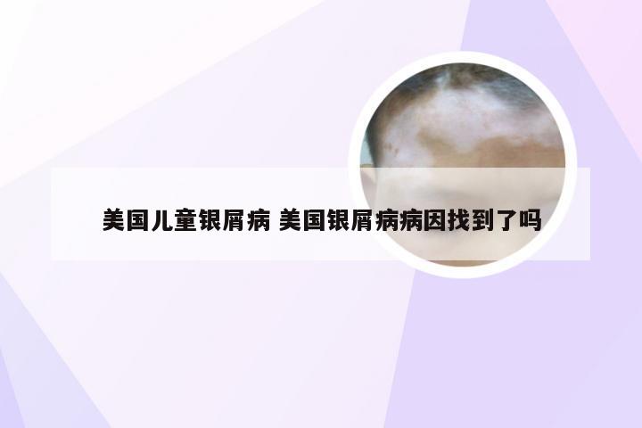美国儿童银屑病 美国银屑病病因找到了吗