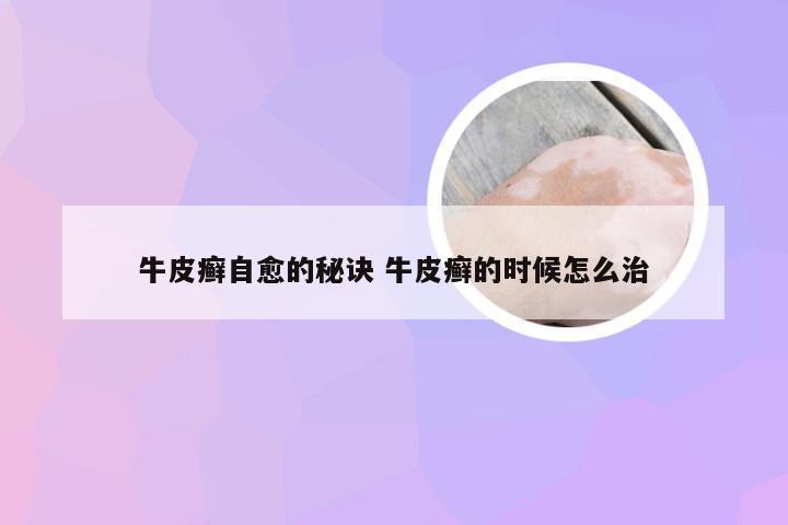 牛皮癣自愈的秘诀 牛皮癣的时候怎么治