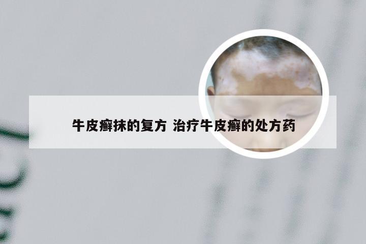 牛皮癣抹的复方 治疗牛皮癣的处方药
