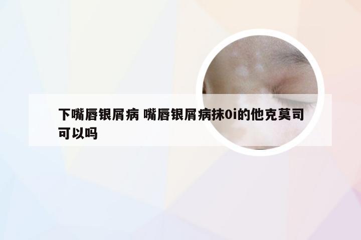 下嘴唇银屑病 嘴唇银屑病抹0i的他克莫司可以吗