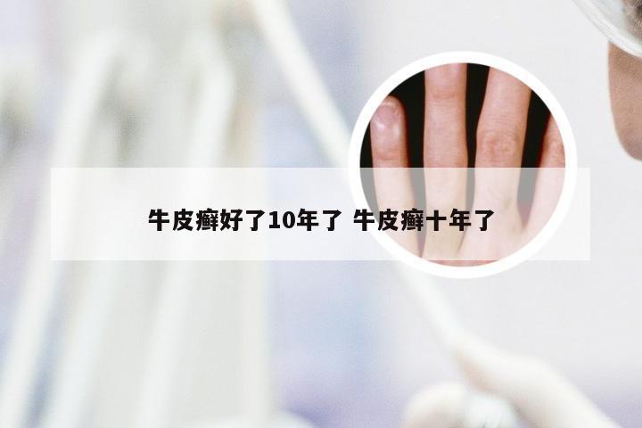 牛皮癣好了10年了 牛皮癣十年了