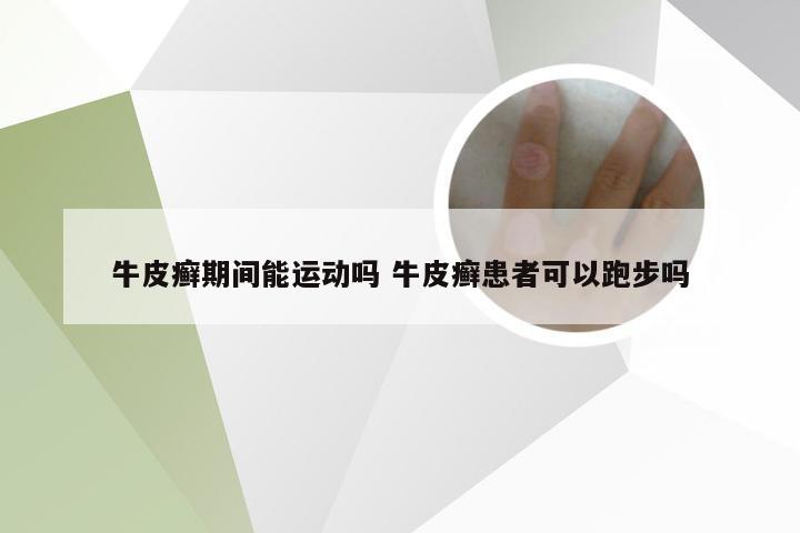 牛皮癣期间能运动吗 牛皮癣患者可以跑步吗