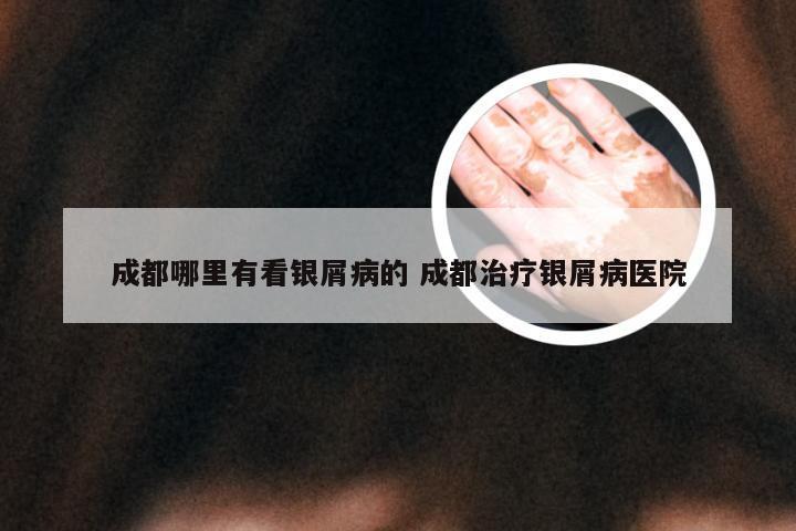 成都哪里有看银屑病的 成都治疗银屑病医院