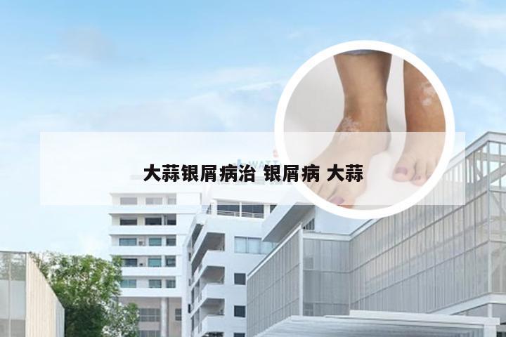 大蒜银屑病治 银屑病 大蒜