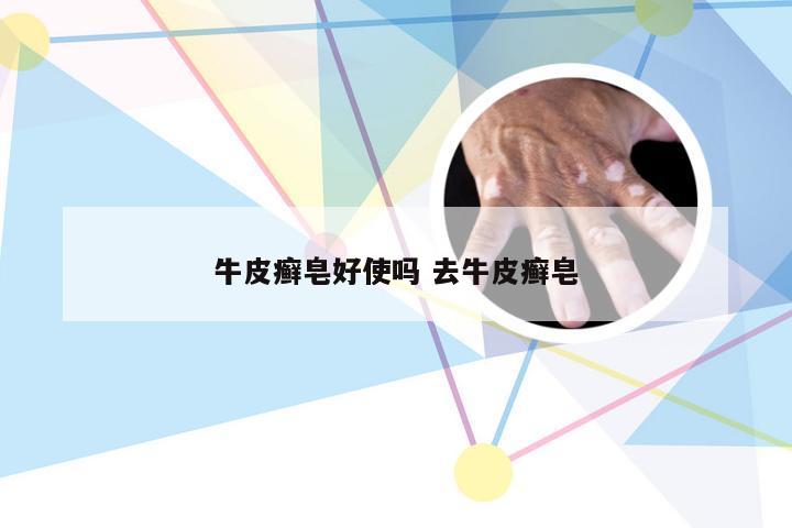 牛皮癣皂好使吗 去牛皮癣皂