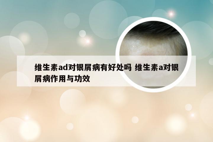 维生素ad对银屑病有好处吗 维生素a对银屑病作用与功效