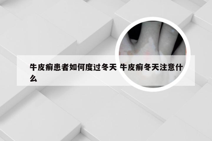 牛皮癣患者如何度过冬天 牛皮癣冬天注意什么