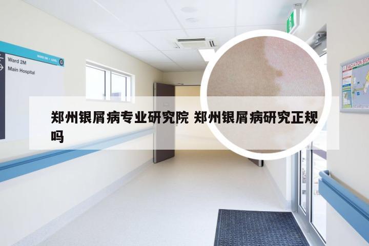 郑州银屑病专业研究院 郑州银屑病研究正规吗