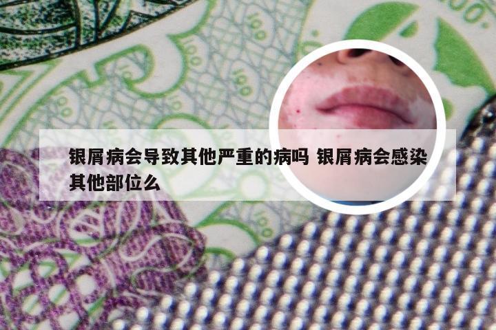 银屑病会导致其他严重的病吗 银屑病会感染其他部位么