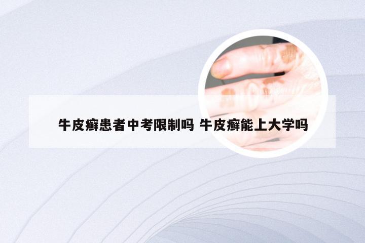牛皮癣患者中考限制吗 牛皮癣能上大学吗