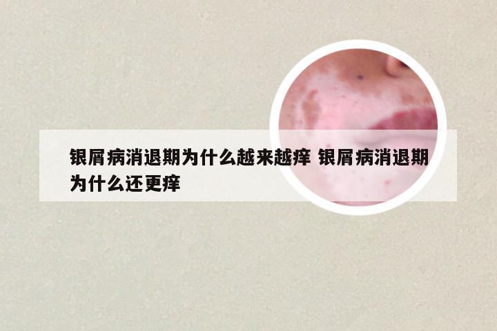 银屑病消退期为什么越来越痒 银屑病消退期为什么还更痒