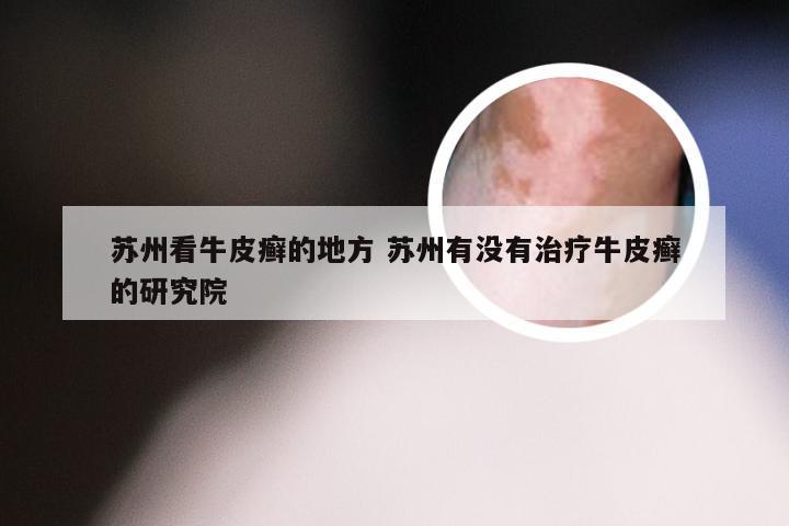苏州看牛皮癣的地方 苏州有没有治疗牛皮癣的研究院