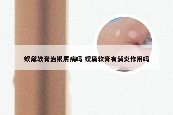 蜈黛软膏治银屑病吗 蜈黛软膏有消炎作用吗