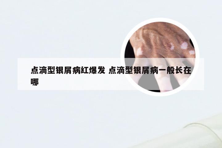 点滴型银屑病红爆发 点滴型银屑病一般长在哪