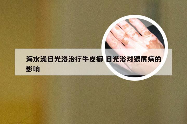 海水澡日光浴治疗牛皮癣 日光浴对银屑病的影响