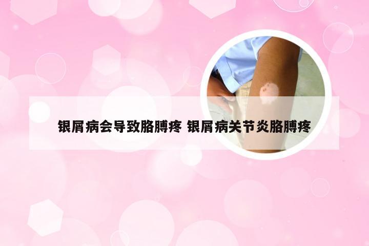 银屑病会导致胳膊疼 银屑病关节炎胳膊疼