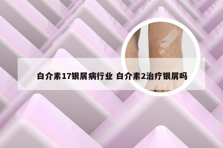 白介素17银屑病行业 白介素2治疗银屑吗