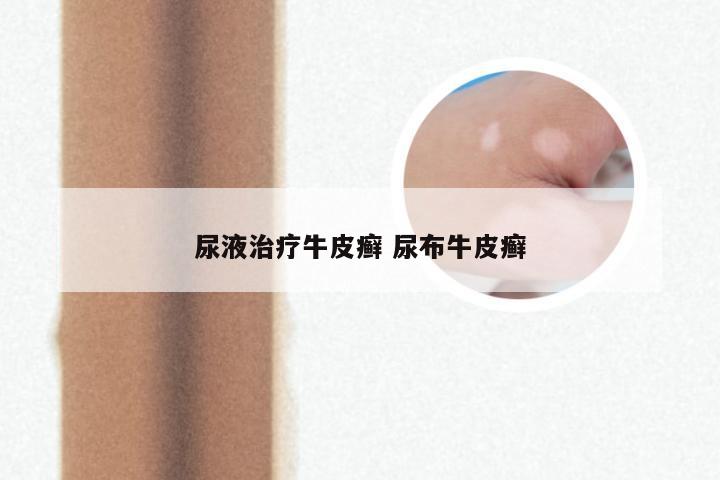 尿液治疗牛皮癣 尿布牛皮癣