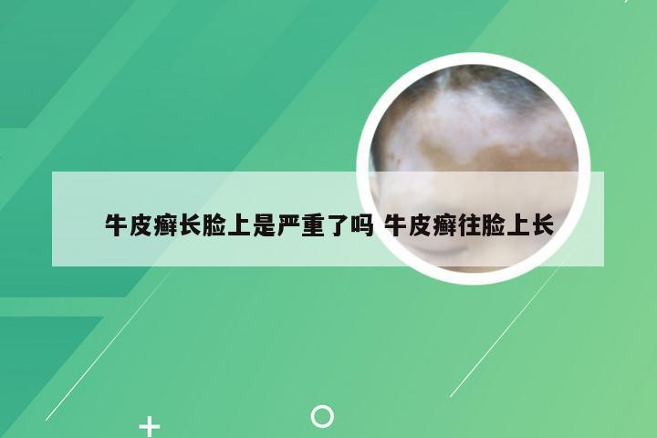 牛皮癣长脸上是严重了吗 牛皮癣往脸上长