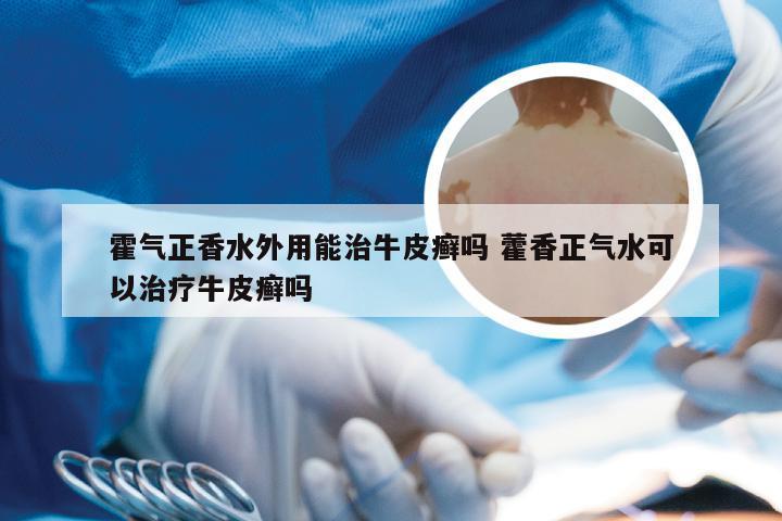 霍气正香水外用能治牛皮癣吗 藿香正气水可以治疗牛皮癣吗