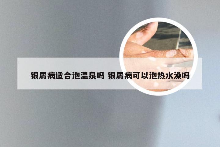 银屑病适合泡温泉吗 银屑病可以泡热水澡吗