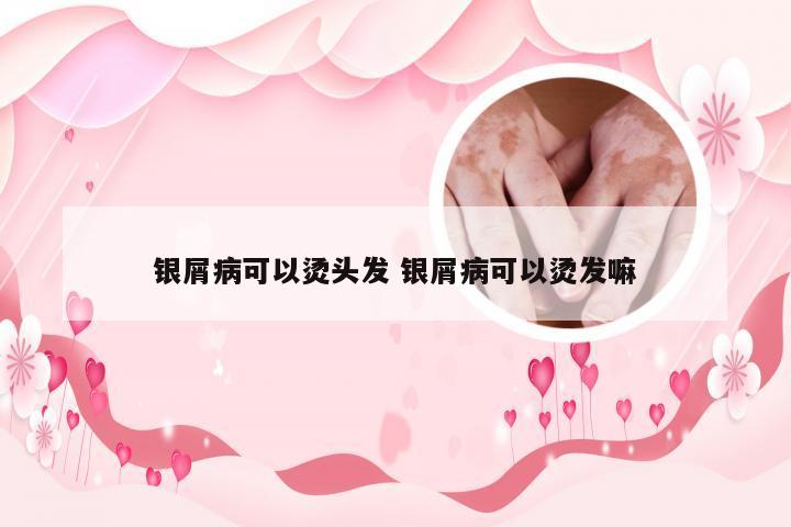 银屑病可以烫头发 银屑病可以烫发嘛