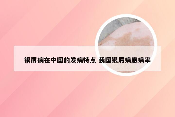 银屑病在中国的发病特点 我国银屑病患病率
