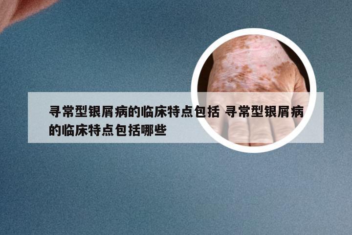 寻常型银屑病的临床特点包括 寻常型银屑病的临床特点包括哪些