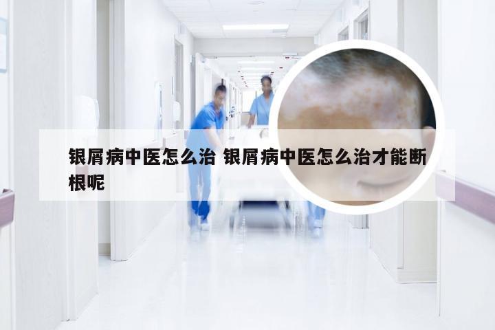 银屑病中医怎么治 银屑病中医怎么治才能断根呢