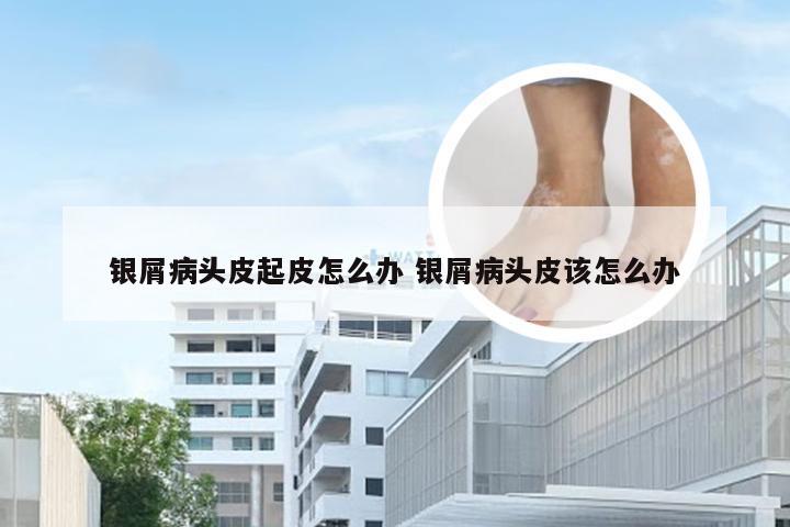 银屑病头皮起皮怎么办 银屑病头皮该怎么办