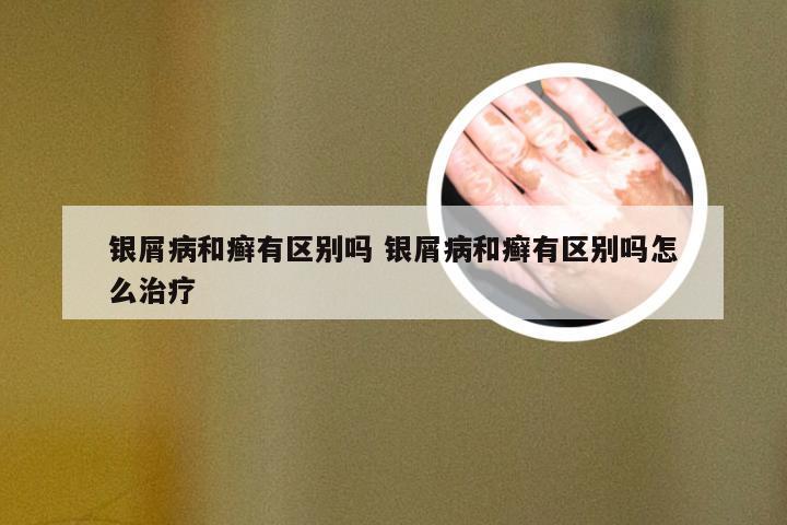 银屑病和癣有区别吗 银屑病和癣有区别吗怎么治疗