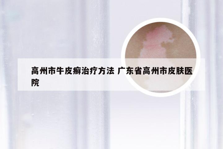 高州市牛皮癣治疗方法 广东省高州市皮肤医院