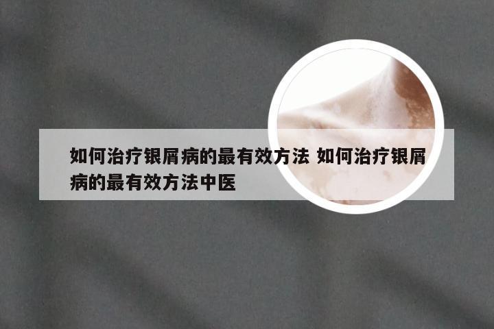 如何治疗银屑病的最有效方法 如何治疗银屑病的最有效方法中医