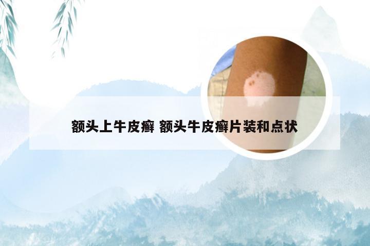 额头上牛皮癣 额头牛皮癣片装和点状
