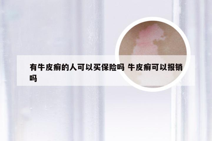 有牛皮癣的人可以买保险吗 牛皮癣可以报销吗