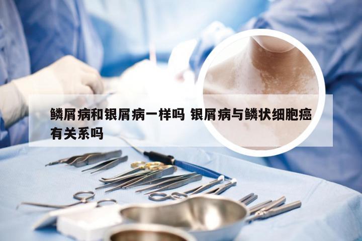 鳞屑病和银屑病一样吗 银屑病与鳞状细胞癌有关系吗