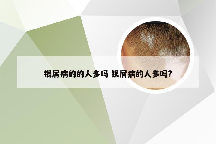 银屑病的的人多吗 银屑病的人多吗?