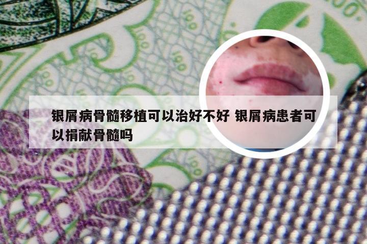 银屑病骨髓移植可以治好不好 银屑病患者可以捐献骨髓吗